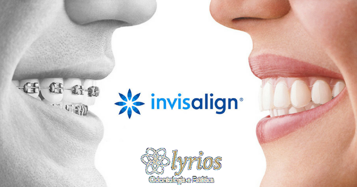 9 perguntas sobre a utilização do aparelho Invisalign® — Clínica